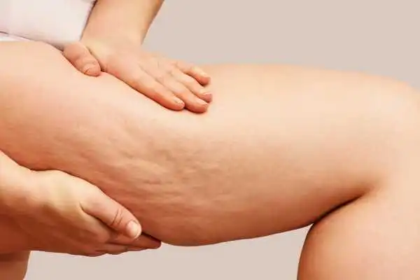 Image of woman showing leg with cellulite Langside