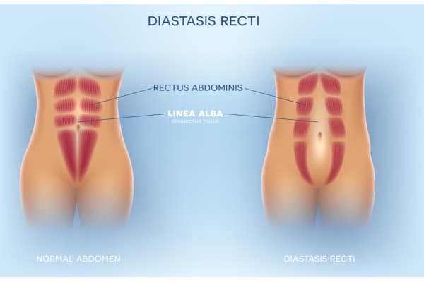 What Non-Surgical Options Are Available for Diastasis Recti Langside?