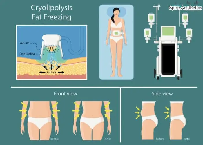 Fat freezing treatment Langside benefits for competitions to remove stubborn fat deposits.